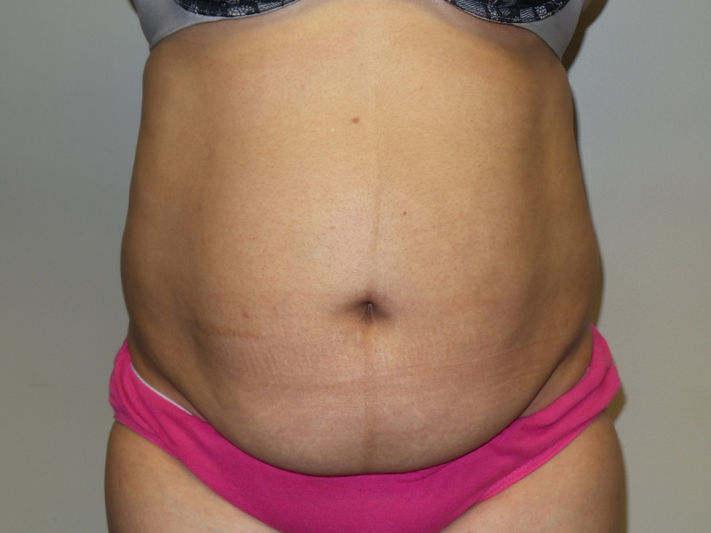 Tummy Tuck Before and After 84 | Sanjay Grover MD FACS