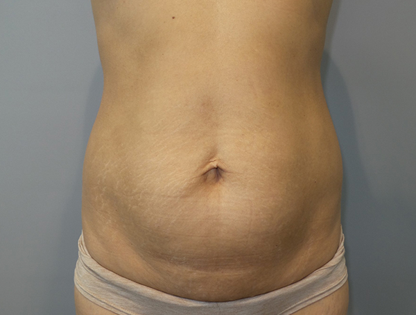 Tummy Tuck Before and After | Grover Aesthetics