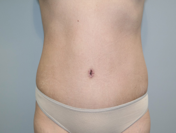 Tummy Tuck Before and After | Grover Aesthetics