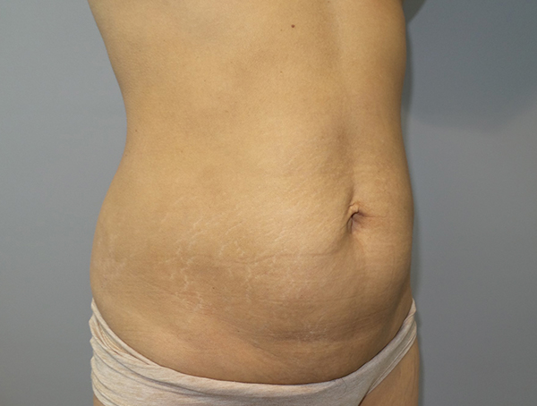 Tummy Tuck Before and After 113 | Sanjay Grover MD FACS