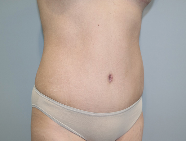 Tummy Tuck Before and After 113 | Sanjay Grover MD FACS