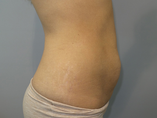 Tummy Tuck Before and After 113 | Sanjay Grover MD FACS