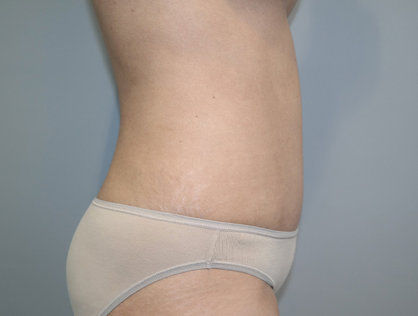 Tummy Tuck Before and After 113 | Grover Aesthetics