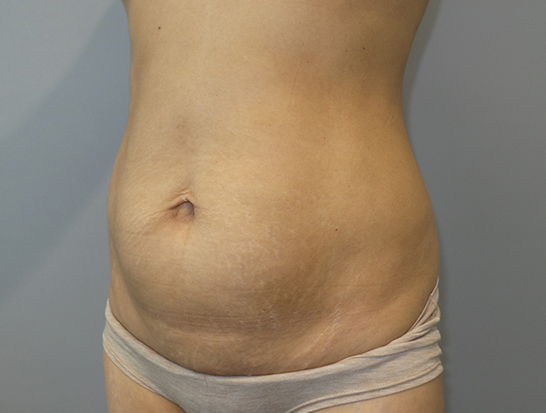 Tummy Tuck Before and After 113 | Sanjay Grover MD FACS