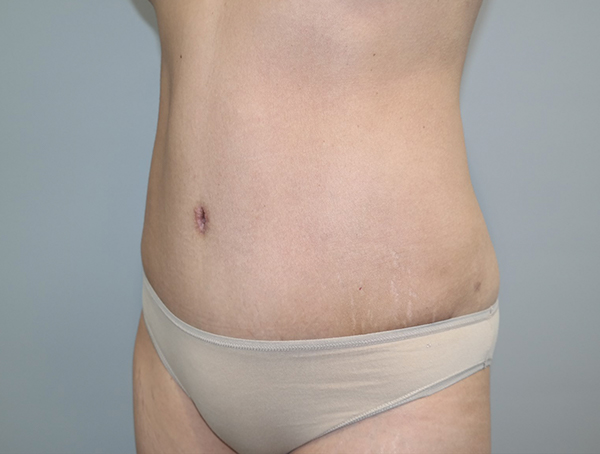 Tummy Tuck Before and After 113 | Sanjay Grover MD FACS