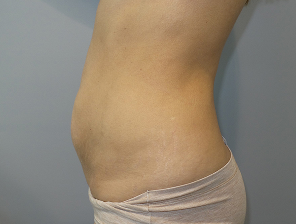 Tummy Tuck Before and After 113 | Sanjay Grover MD FACS