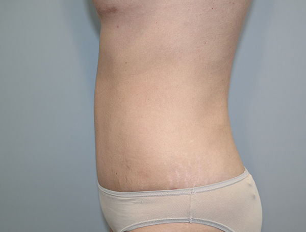 Tummy Tuck Before and After 113 | Grover Aesthetics