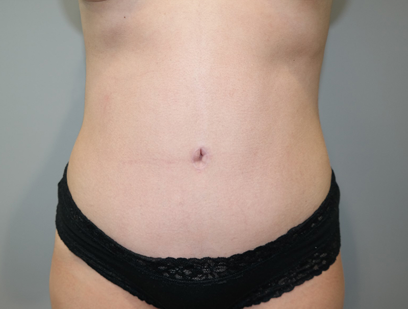 Tummy Tuck Before and After | Grover Aesthetics