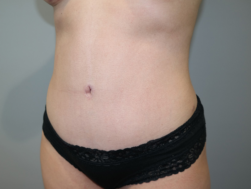 Tummy Tuck Before and After 114 | Sanjay Grover MD FACS