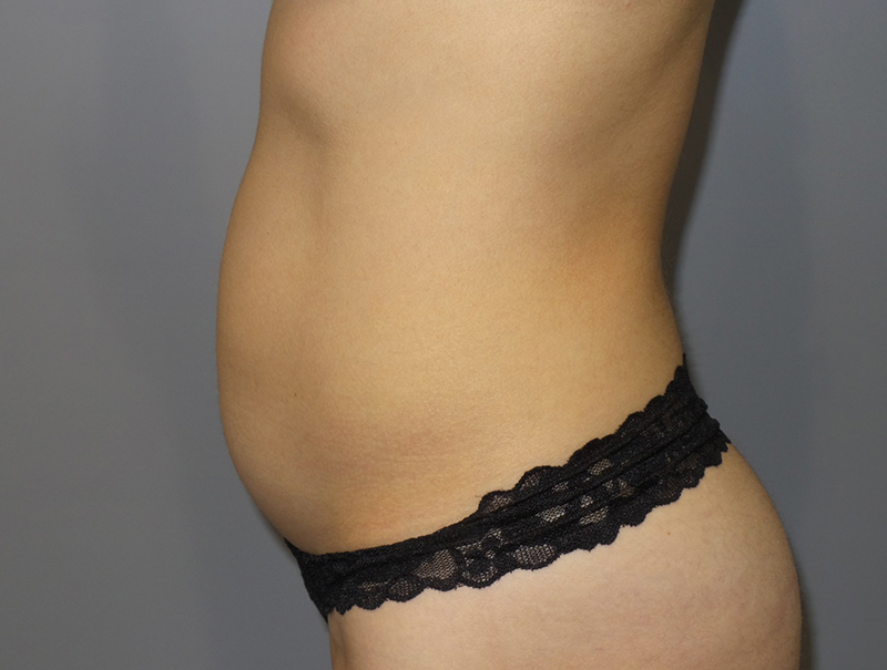 Tummy Tuck Before and After 114 | Sanjay Grover MD FACS