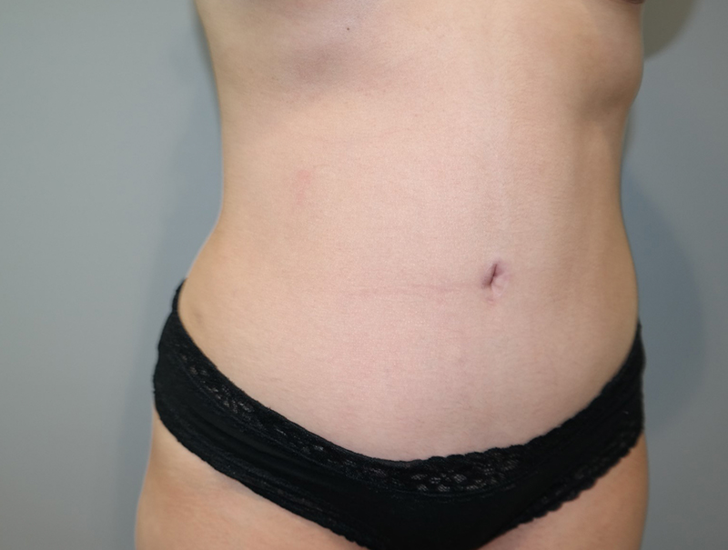 Tummy Tuck Before and After 114 | Sanjay Grover MD FACS