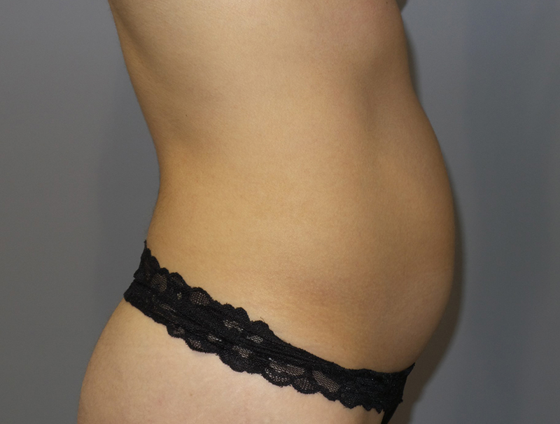 Tummy Tuck Before and After 114 | Sanjay Grover MD FACS