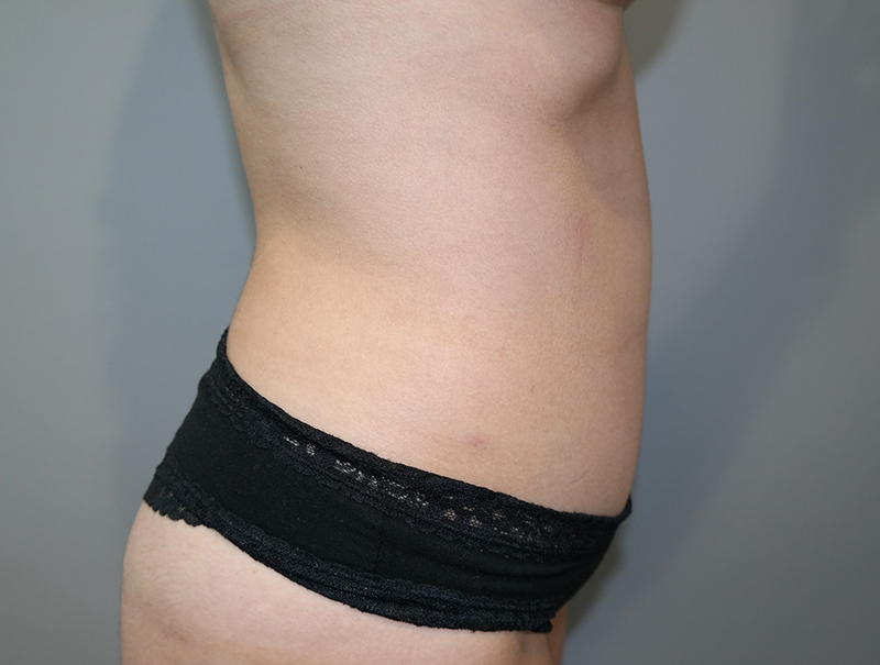 Tummy Tuck Before and After 114 | Sanjay Grover MD FACS