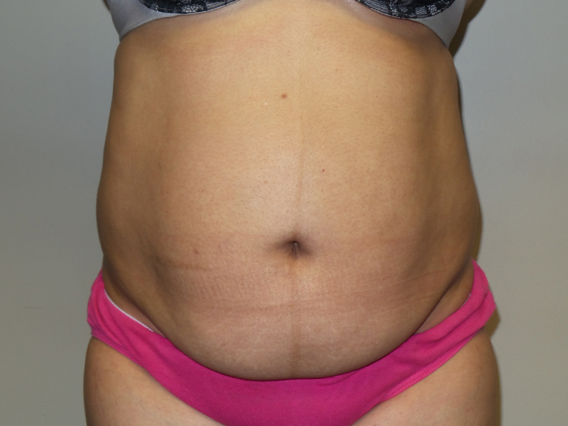 Tummy Tuck Before and After 01 | Sanjay Grover MD FACS