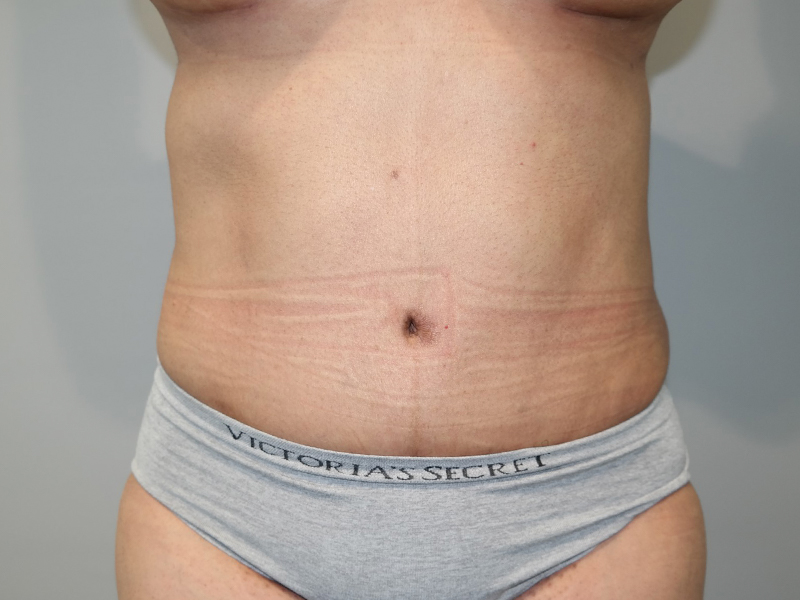 Tummy Tuck Before and After | Grover Aesthetics