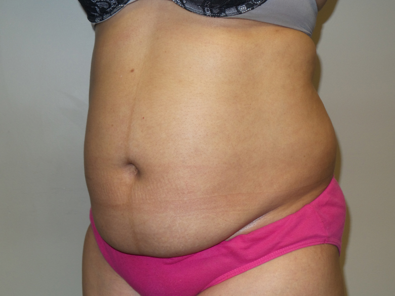 Tummy Tuck Before and After 115 | Grover Aesthetics