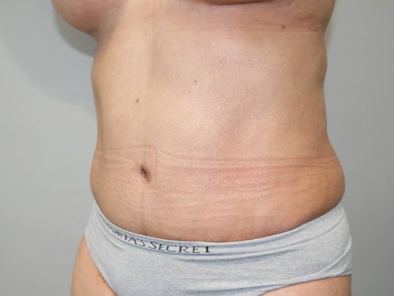 Tummy Tuck Before and After 115 | Sanjay Grover MD FACS