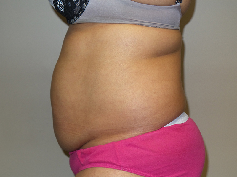 Tummy Tuck Before and After 115 | Sanjay Grover MD FACS