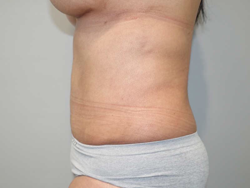 Tummy Tuck Before and After 115 | Grover Aesthetics
