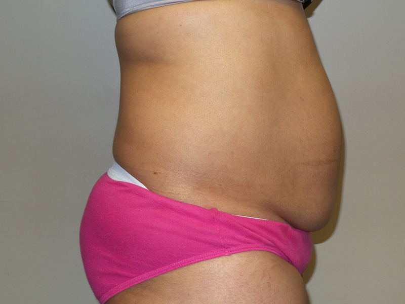 Tummy Tuck Before and After 115 | Sanjay Grover MD FACS