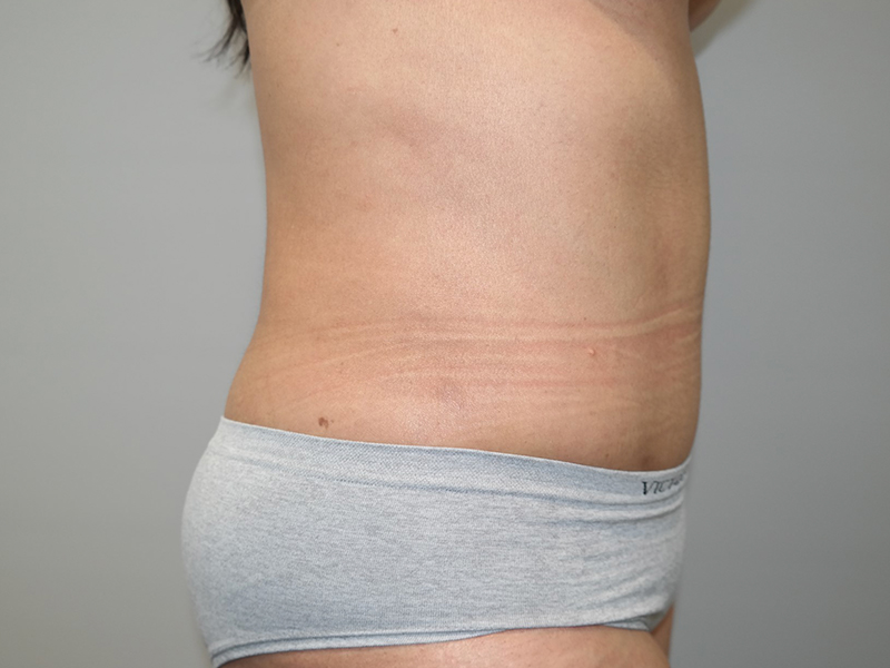 Tummy Tuck Before and After 115 | Sanjay Grover MD FACS