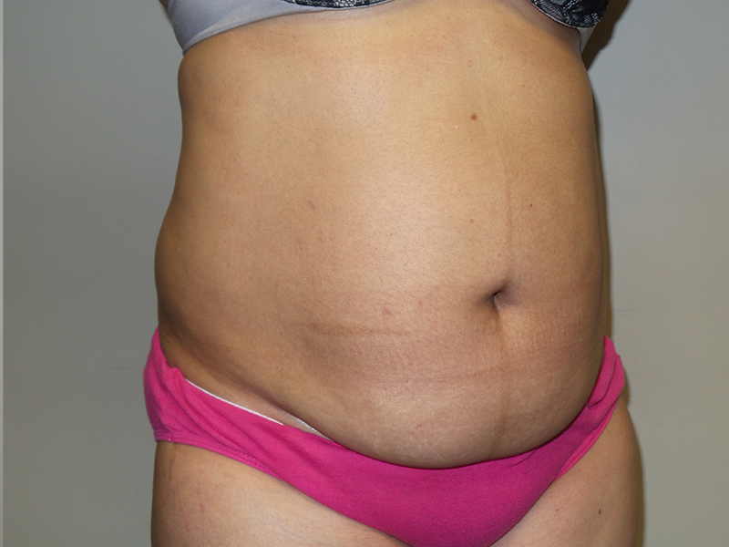 Tummy Tuck Before and After 115 | Grover Aesthetics