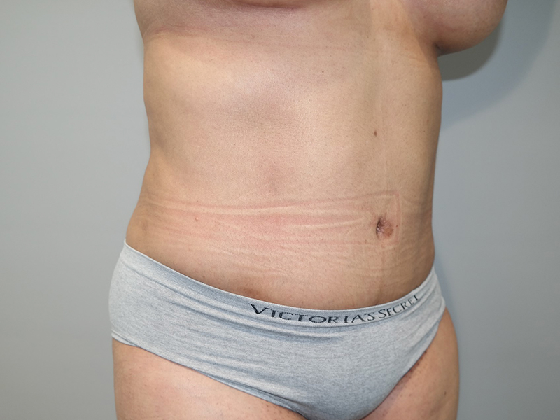 Tummy Tuck Before and After 115 | Sanjay Grover MD FACS