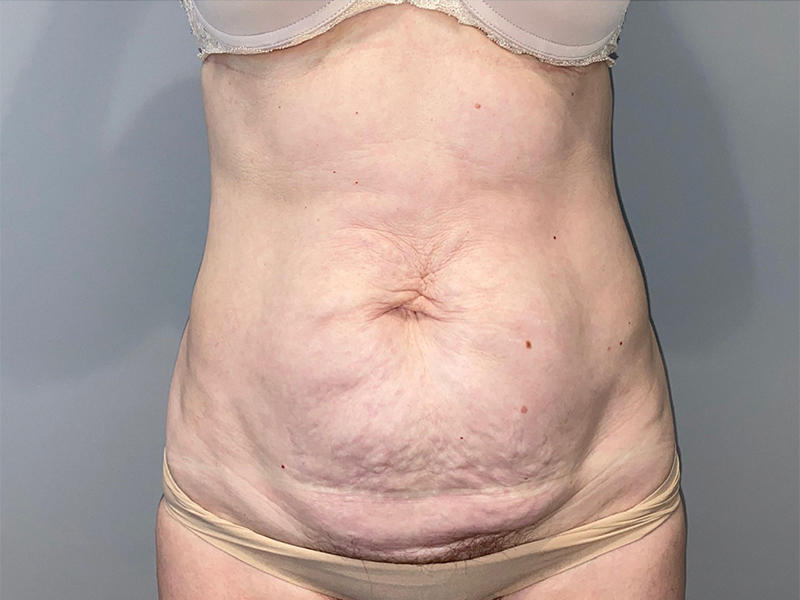 Tummy Tuck Before and After 80 | Sanjay Grover MD FACS