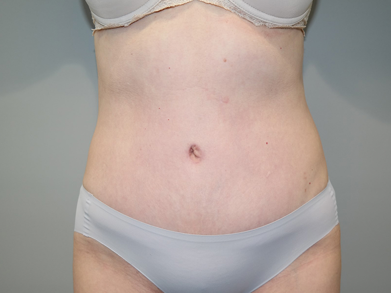Tummy Tuck Before and After | Grover Aesthetics
