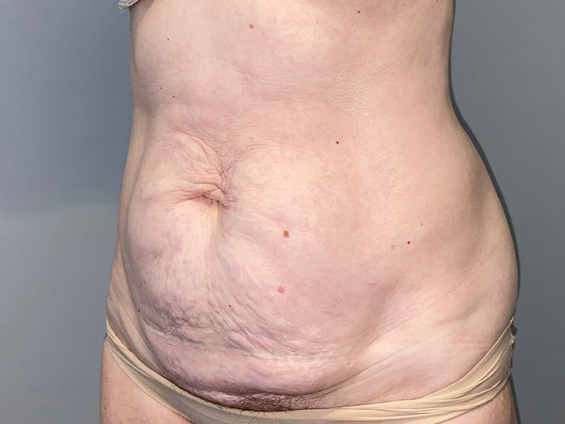 Tummy Tuck Before and After 116 | Sanjay Grover MD FACS