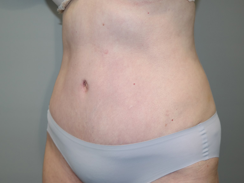 Tummy Tuck Before and After 116 | Grover Aesthetics