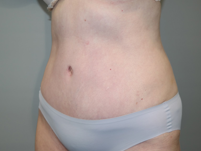 Tummy Tuck Before and After 116 | Sanjay Grover MD FACS