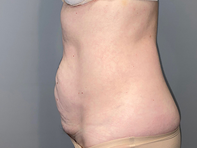Tummy Tuck Before and After 116 | Grover Aesthetics