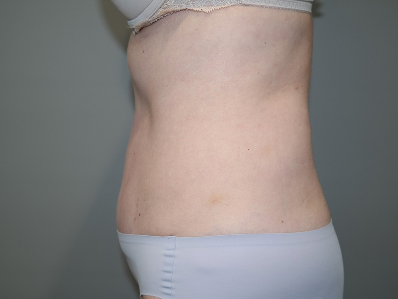 Tummy Tuck Before and After 116 | Sanjay Grover MD FACS