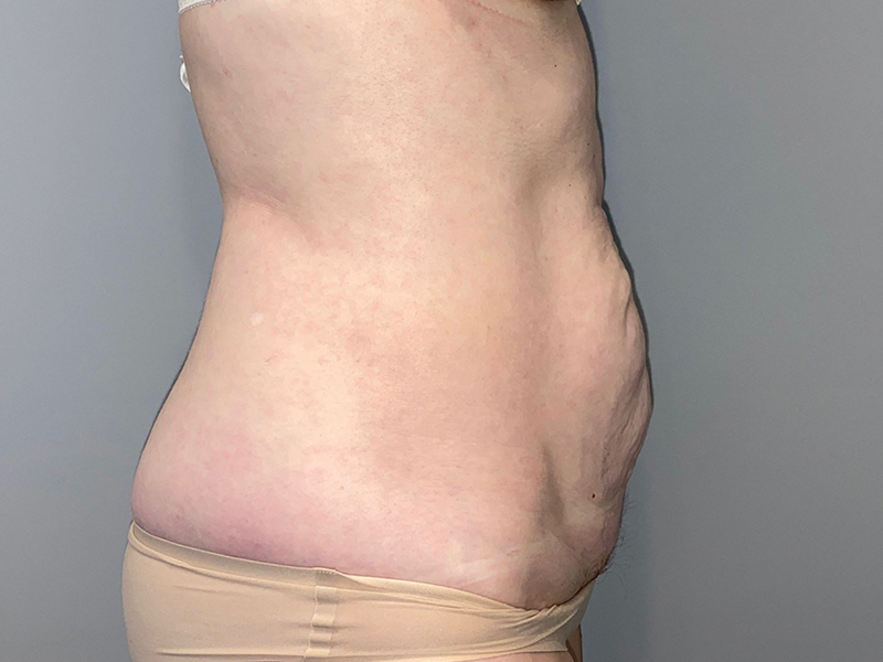 Tummy Tuck Before and After 116 | Sanjay Grover MD FACS