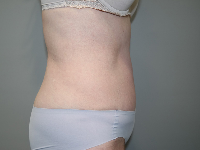 Tummy Tuck Before and After 116 | Sanjay Grover MD FACS