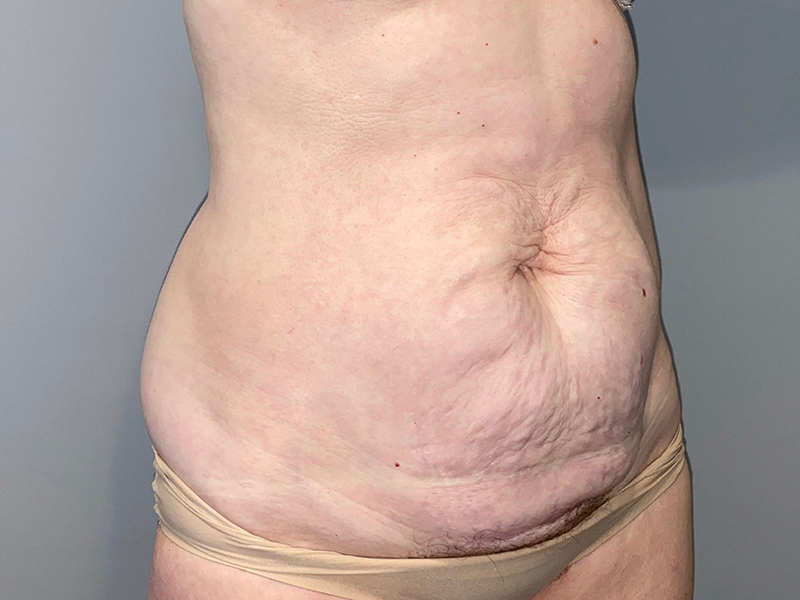 Tummy Tuck Before and After 116 | Sanjay Grover MD FACS