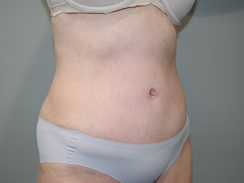 Tummy Tuck Before and After 116 | Sanjay Grover MD FACS