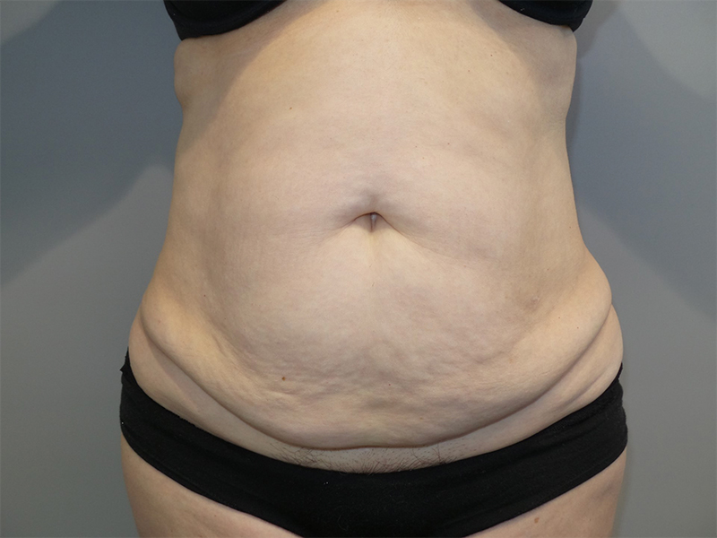 Tummy Tuck Before and After 63 | Sanjay Grover MD FACS