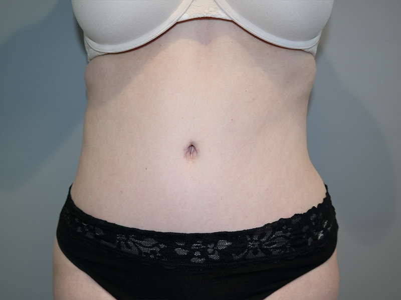 Tummy Tuck Before and After 117 | Sanjay Grover MD FACS