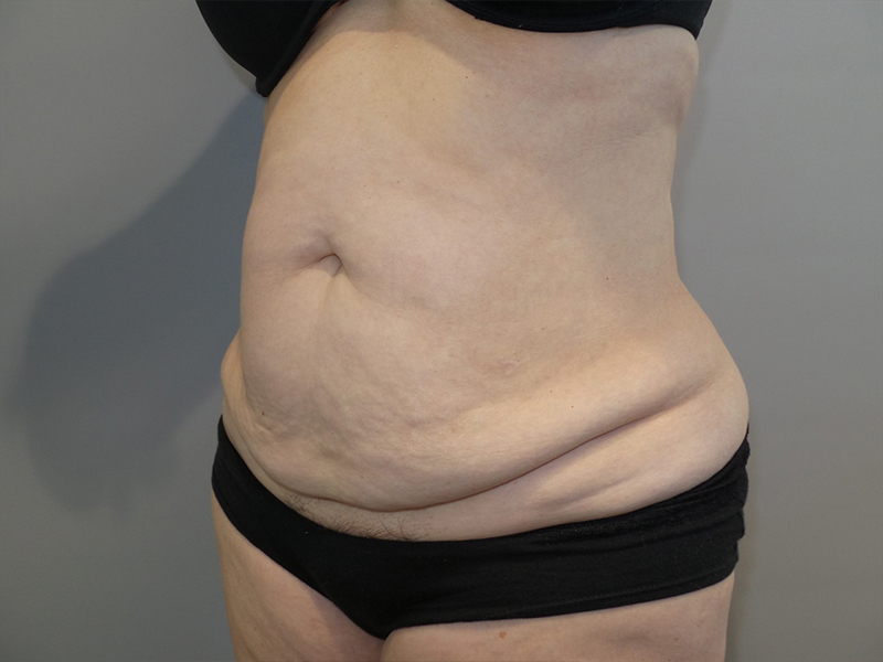 Tummy Tuck Before and After 117 | Grover Aesthetics