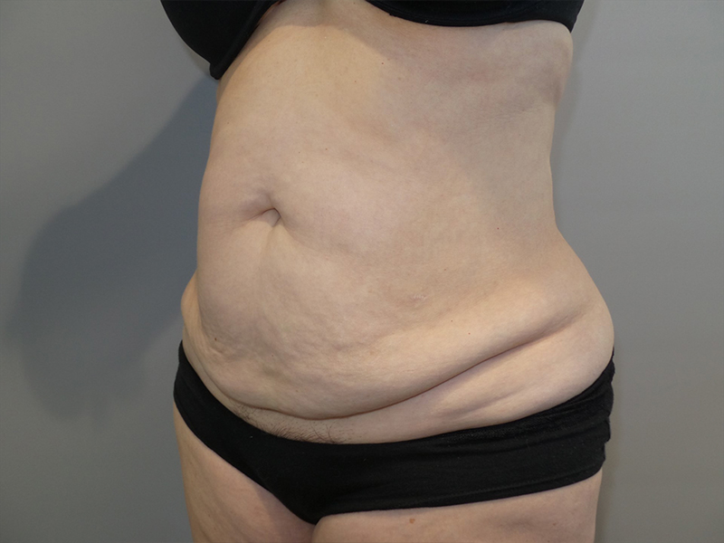 Tummy Tuck Before and After 117 | Sanjay Grover MD FACS