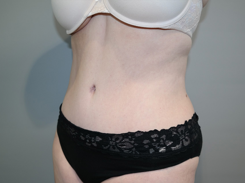 Tummy Tuck Before and After 117 | Sanjay Grover MD FACS