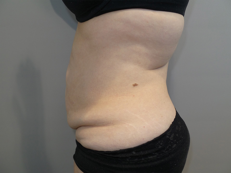 Tummy Tuck Before and After 117 | Sanjay Grover MD FACS