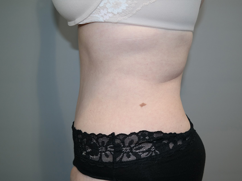 Tummy Tuck Before and After 117 | Sanjay Grover MD FACS