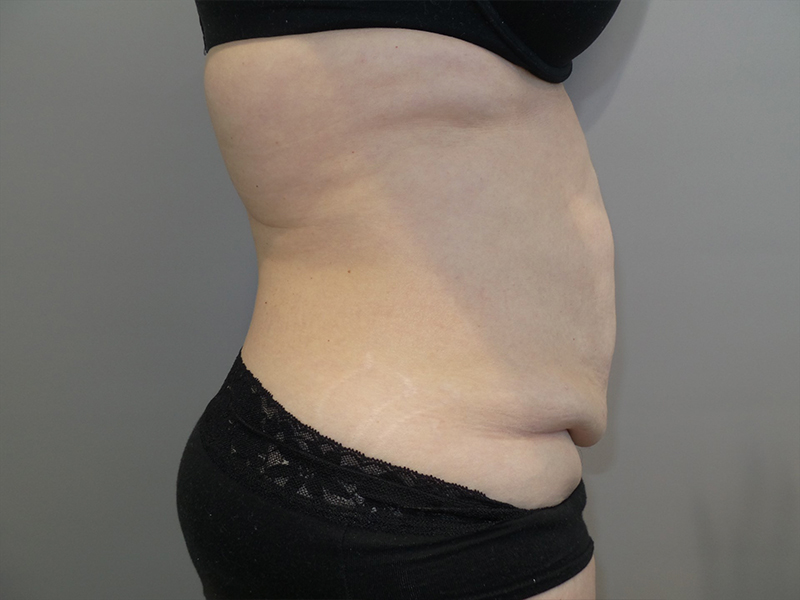 Tummy Tuck Before and After 117 | Sanjay Grover MD FACS