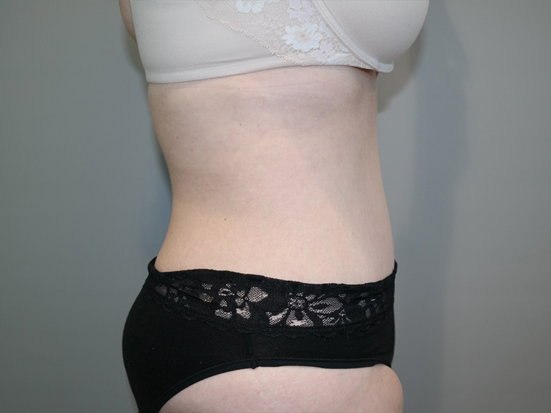 Tummy Tuck Before and After 117 | Grover Aesthetics