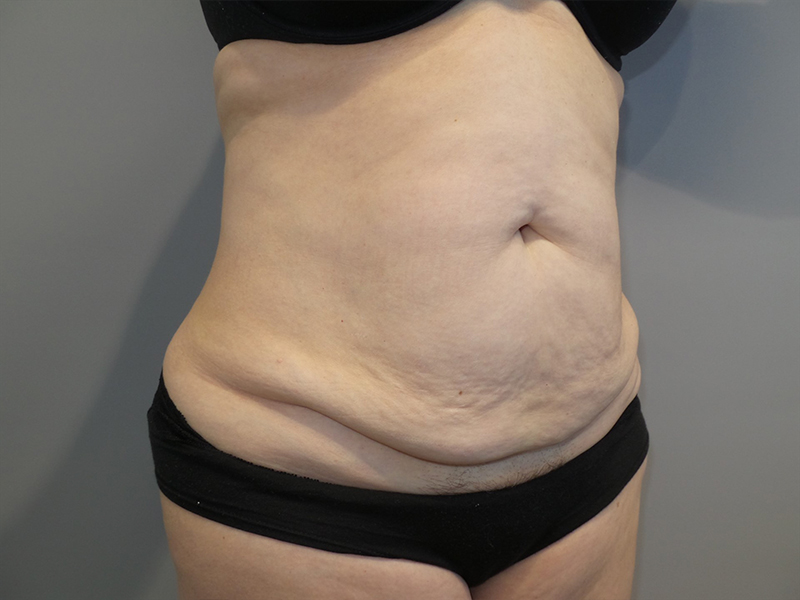 Tummy Tuck Before and After 117 | Sanjay Grover MD FACS