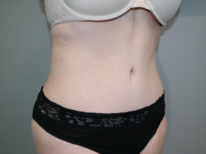 Tummy Tuck Before and After 117 | Sanjay Grover MD FACS