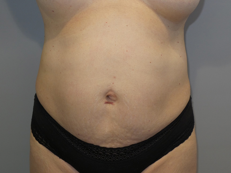 Tummy Tuck Before and After | Grover Aesthetics